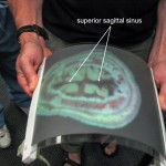 Curved Cross section illustrating Superior Sagittal Sinus